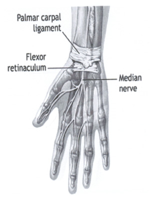 carpal_tunnel_syndrome