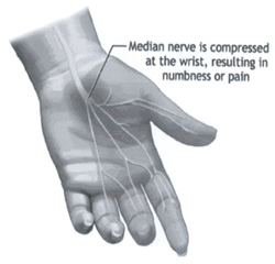 carpal_tunnel_syndrome